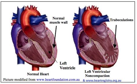 symptoms of lv noncompaction